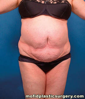 Tummy Tuck Case 2761 Before Photo Tummy Tuck