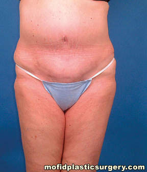 Tummy Tuck Case 2761 After Photo Tummy Tuck
