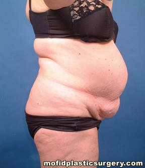 Tummy Tuck Case 2761 Before Photo Tummy Tuck