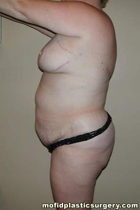 Tummy Tuck Case 2767 Before Photo Tummy Tuck