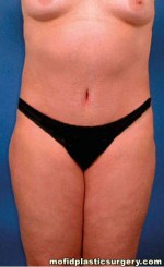 Tummy Tuck