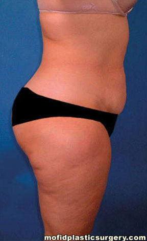 Tummy Tuck Case 2775 Before Photo Tummy Tuck