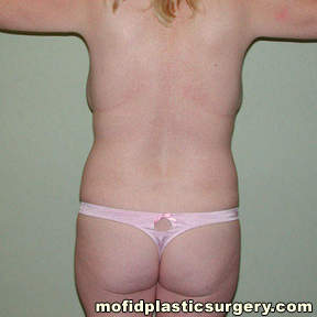 Tummy Tuck Case 2783 Before Photo Tummy Tuck