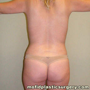 Tummy Tuck Case 2783 After Photo Tummy Tuck