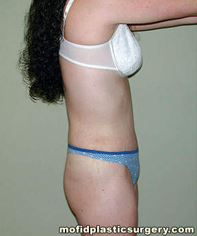Tummy Tuck Case 2791 After Photo Tummy Tuck