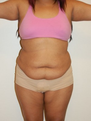 Tummy Tuck Case 2797 Before Photo Tummy Tuck