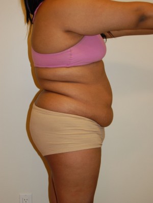 Tummy Tuck Case 2797 Before Photo Tummy Tuck