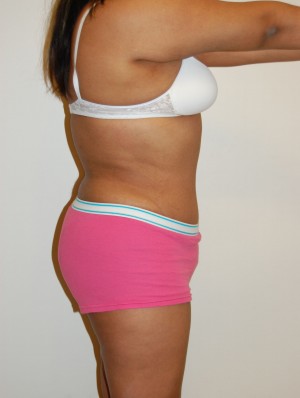 Tummy Tuck Case 2797 After Photo Tummy Tuck