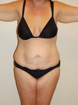 Tummy Tuck Case 2805 Before Photo Tummy Tuck