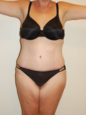 Tummy Tuck Case 2805 After Photo Tummy Tuck