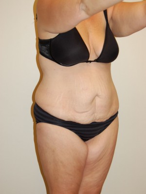 Tummy Tuck Case 2805 Before Photo Tummy Tuck