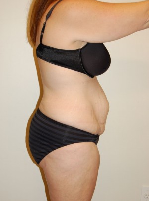 Tummy Tuck Case 2805 Before Photo Tummy Tuck