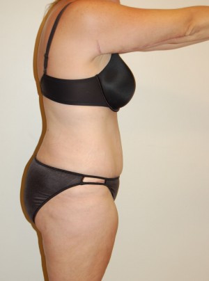Tummy Tuck Case 2805 After Photo Tummy Tuck