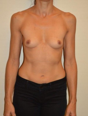 Breast Augmentation Case 2813 Before Photo Breast Augmentation