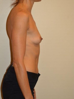 Breast Augmentation Case 2813 Before Photo Breast Augmentation