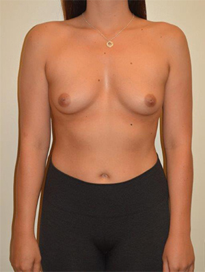 Breast Augmentation Case 2821 Before Photo Breast Augmentation