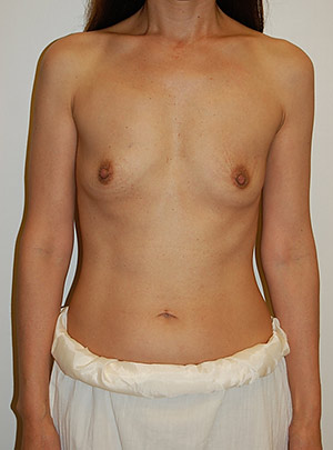 Breast Augmentation Case 2837 Before Photo Breast Augmentation