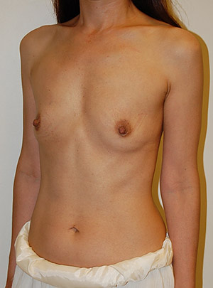 Breast Augmentation Case 2837 Before Photo Breast Augmentation