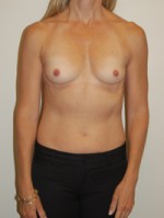 Breast Augmentation