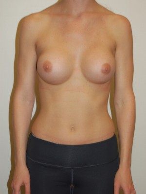 Breast Augmentation Case 2885 After Photo Breast Augmentation