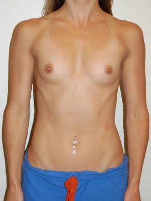 Breast Augmentation