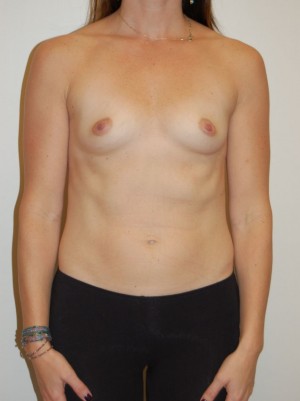 Breast Augmentation