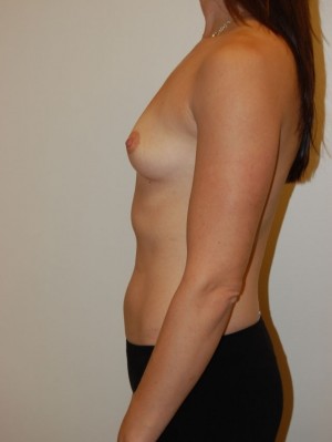 Breast Augmentation
