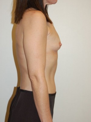 Breast Augmentation