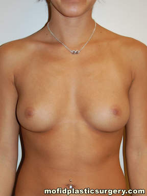 Breast Augmentation