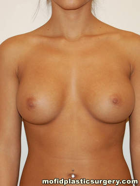 Breast Augmentation