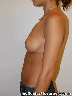 Breast Augmentation