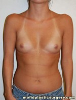 Breast Augmentation