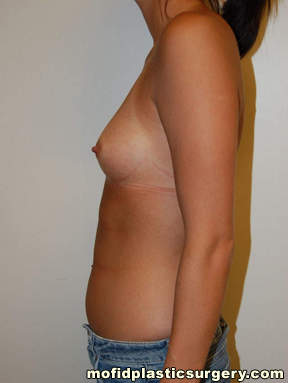 Breast Augmentation