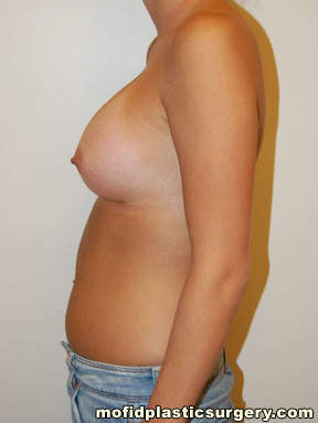 Breast Augmentation