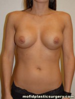 Breast Augmentation