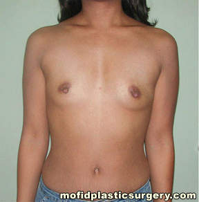 Breast Augmentation Case 3025 Before Photo Breast Augmentation