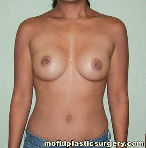 Breast Augmentation Case 3025 After Photo Breast Augmentation