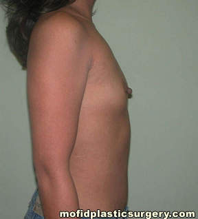 Breast Augmentation Case 3025 Before Photo Breast Augmentation