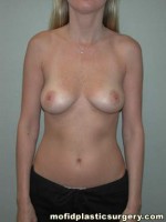 Breast Augmentation