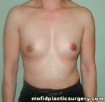 Breast Augmentation