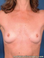 Breast Augmentation