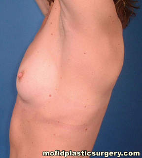 Breast Augmentation Case 3049 Before Photo Breast Augmentation