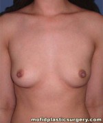 Breast Augmentation