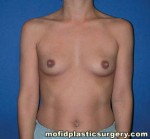 Breast Augmentation