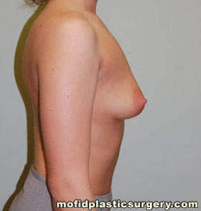 Breast Augmentation Case 3111 Before Photo Breast Augmentation