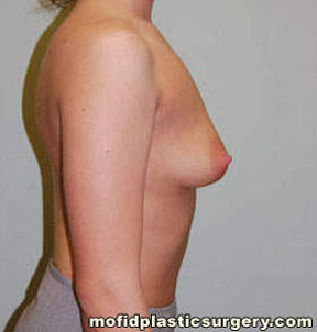 Breast Augmentation