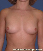 Breast Augmentation