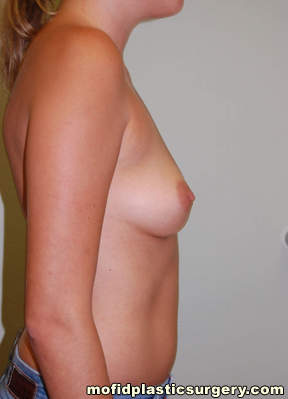 Breast Augmentation Case 3127 Before Photo Breast Augmentation