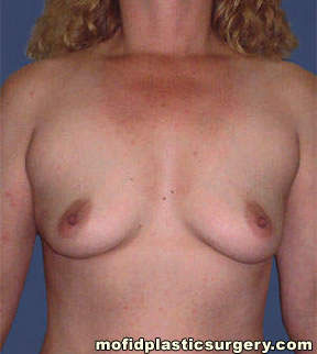 Breast Augmentation Case 3137 Before Photo Breast Augmentation