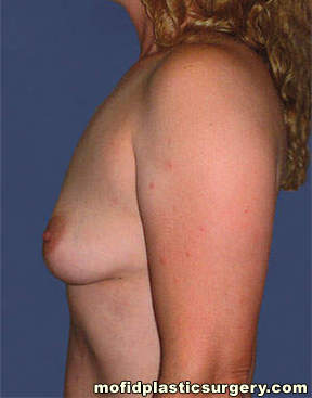 Breast Augmentation Case 3137 Before Photo Breast Augmentation